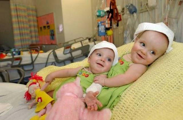 تصاویر زیبا از زندگی مجدد دوقلوهای به هم چسبیده