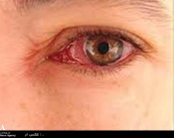 عوارض چشمی در کمین سیگاری های مبتلا به پرکاری تیروئید