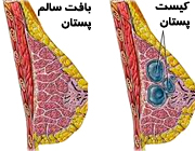 کیست پستان