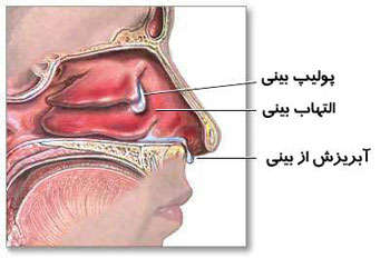 دلیل گرفتگی بینی چیست؟ Vakonesh.Com c4ca4238a0b923820dcc509a6f75849b131 دلیل گرفتگی بینی چیست؟